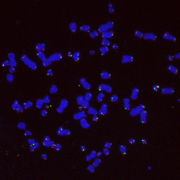 Chromosomes of a tumor cell that extend their telomeres (pink and green) on the...
