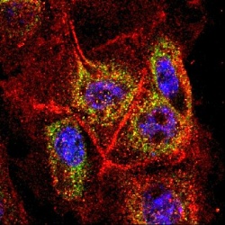 Krebszellen aus der Bauchspeicheldrüse unter dem Fluoreszenzmikroskop.
