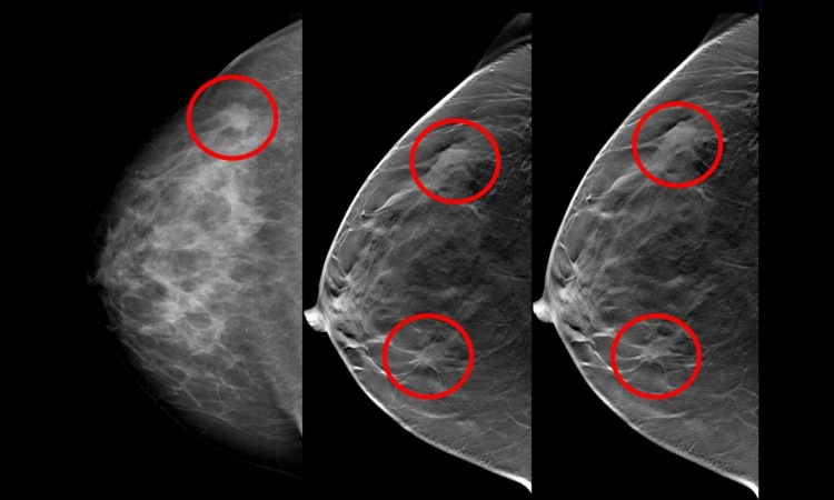 Brustkrebsdiagnostik Unsichtbares Sichtbar Machen