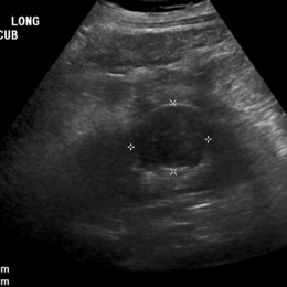 83 year old male presents with bladder outlet obstruction from benign prostatic...