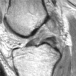 1a. Five days following injury, sagittal MRI image shows mid-substance...