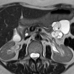 MRI of serous cystadenoma