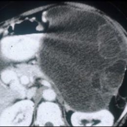CT of mucinous cystadenoma