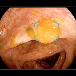 Serrated polyp covered with stool