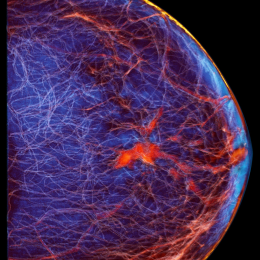 View of the breast and breast tissue. The red spot at center is a tumor in the...