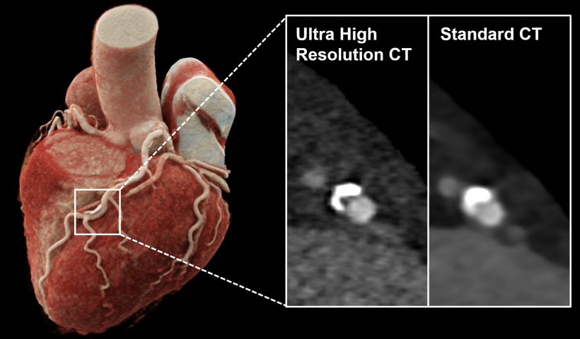 3D-Rekonstruktionen einer Computertomographie des Herzens mit Verkalkungen der...