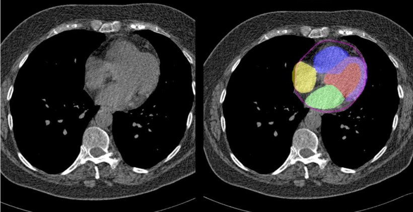 side-by-side comparison of cardiac ct scans, with and without ai enhancements