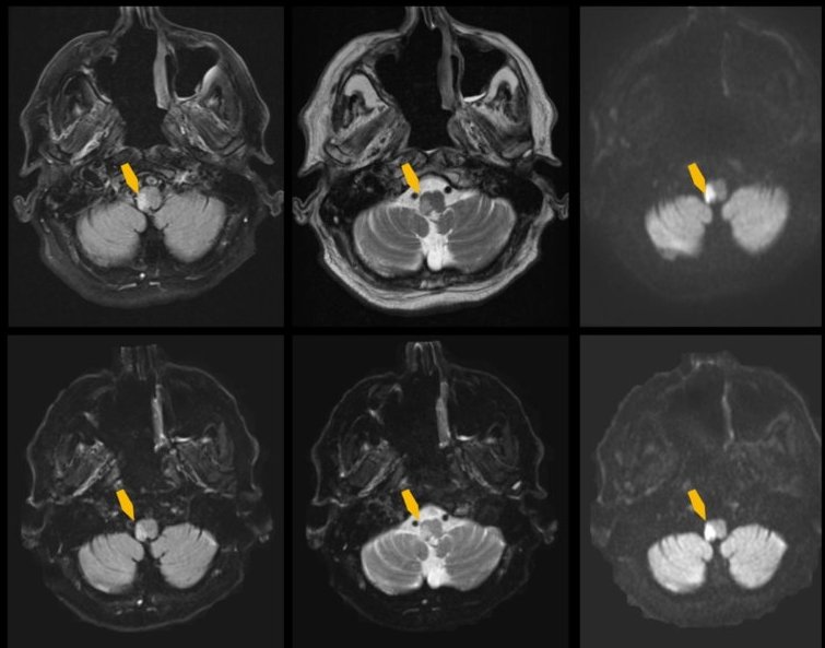 MRT-Aufnahmen des Gehirns einer Patientin mit einem akuten ischämischen...