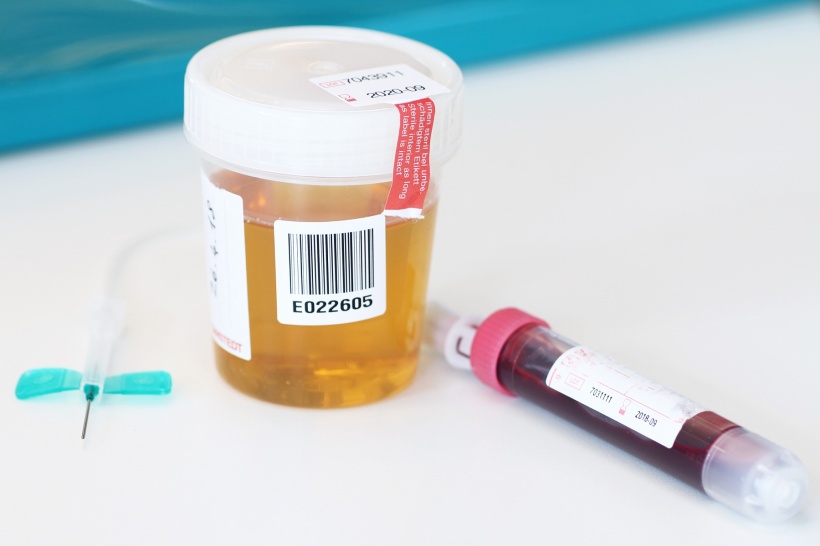 Das CAU-Forschungsteam möchte zur Krebsdiagnose künftig Urin statt Blut...