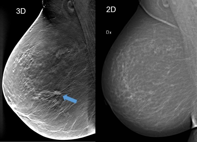 3d tomosynthesis and 2d mammography imaging of a breast