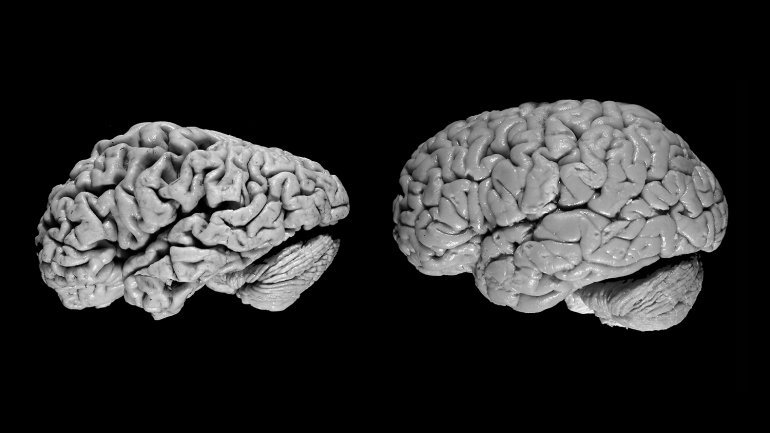 The brain of a person with Alzheimer’s (left) compared with the brain of a...