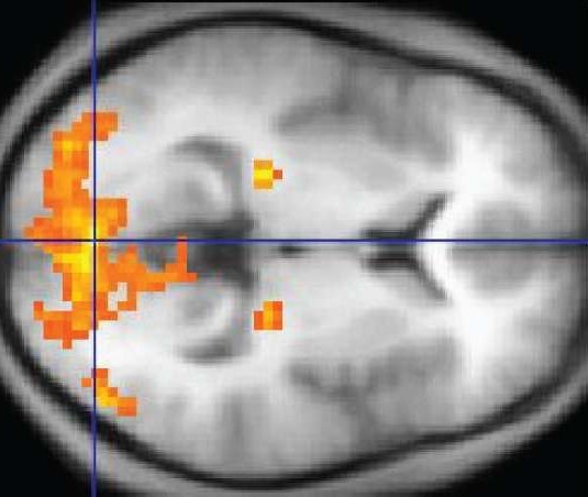 An fMRI image with yellow areas showing increased activity.