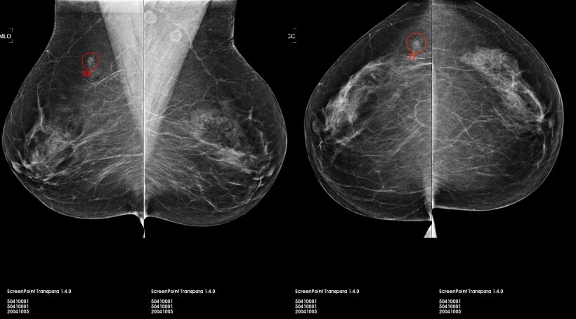 Transpara, the AI software for 2-D and 3-D mammography, developed at...