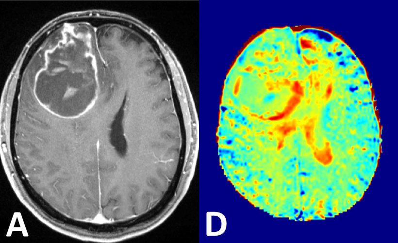Left: brain tumour in conventional contrast-enhanced MRI; 
Right: glucose MRI...