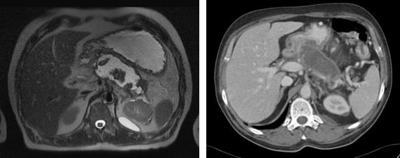 Patient mit nekrotisierender akuter Pankreatitis (links) T2-gewichtete MRT mit...
