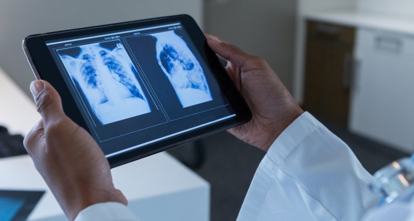 AI auto-scans lung X-rays for coronavirus