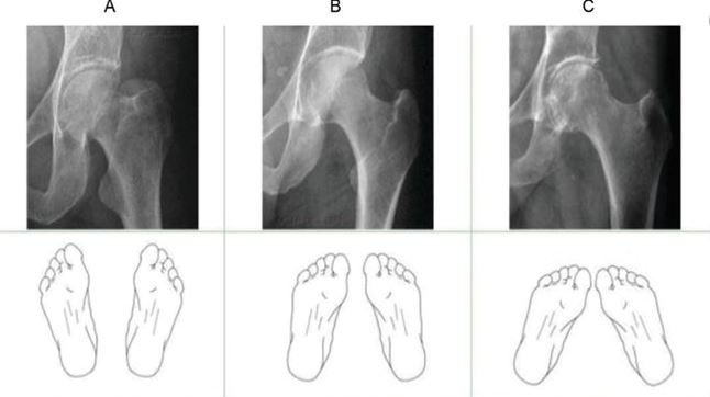 The effect of feet positioning to avoid foreshortening or elongation of the...