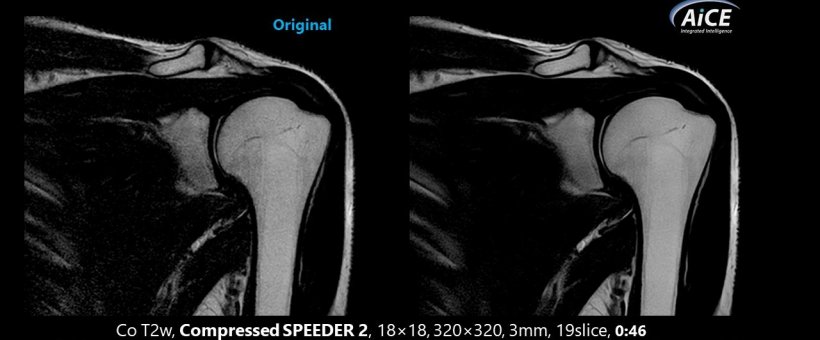 AI-enhanced imaging demonstrated on a shoulder T2w MRI scan