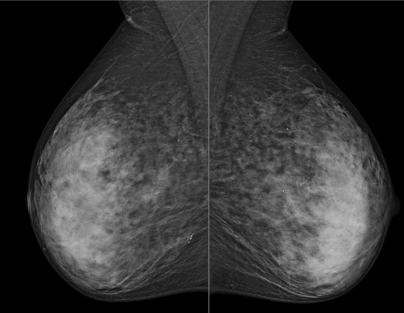 Digital mammography (MLO) without suspicous findings (BIRADS-2) in low...