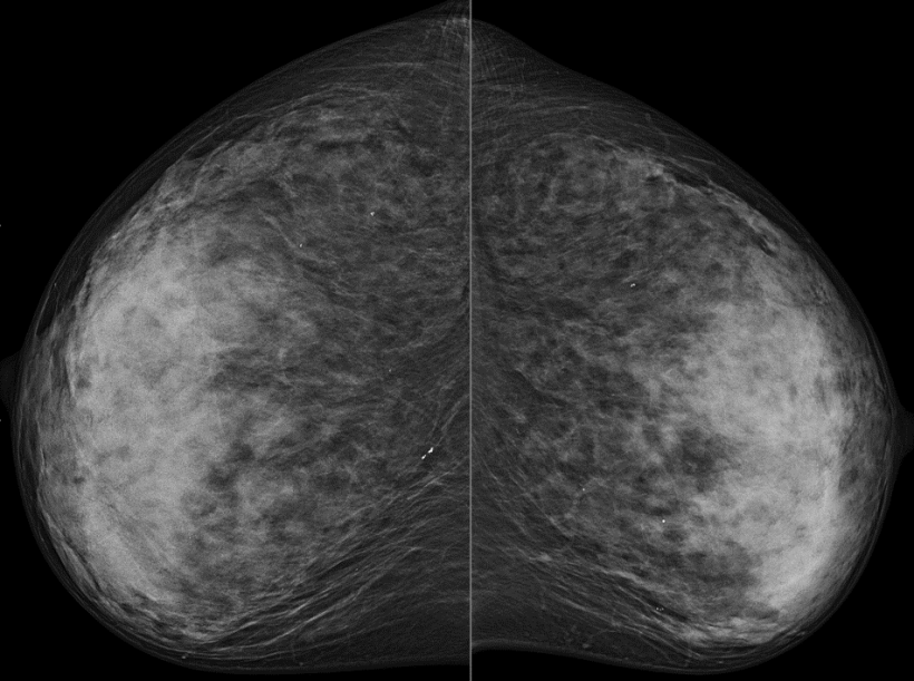 Digital mammography (CC) without suspicous findings (BIRADS-2) in low...