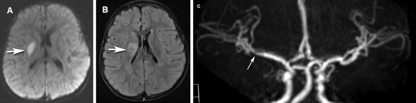 Two and a half year old boy. Left hemiplegia discovered as the patient woke in...