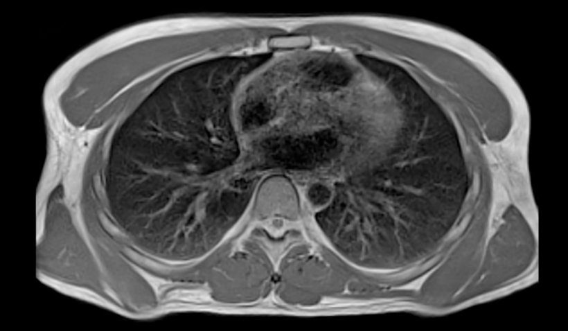 Magnetom Free.Max provides superior image quality for the lung parenchyma which...