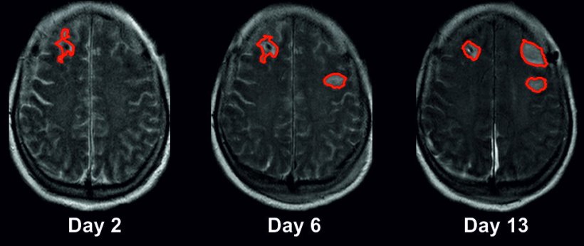 MRI images of a female patient’s brain taken on days 2, 6 and 13 after a...