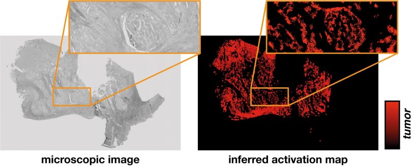 Aus dem mikroskopischen Bild einer Gewebeprobe (links) leitet das neuronale...