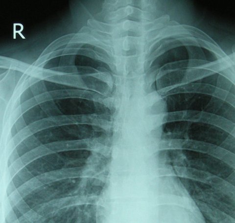 lung x-ray of a healthy person
