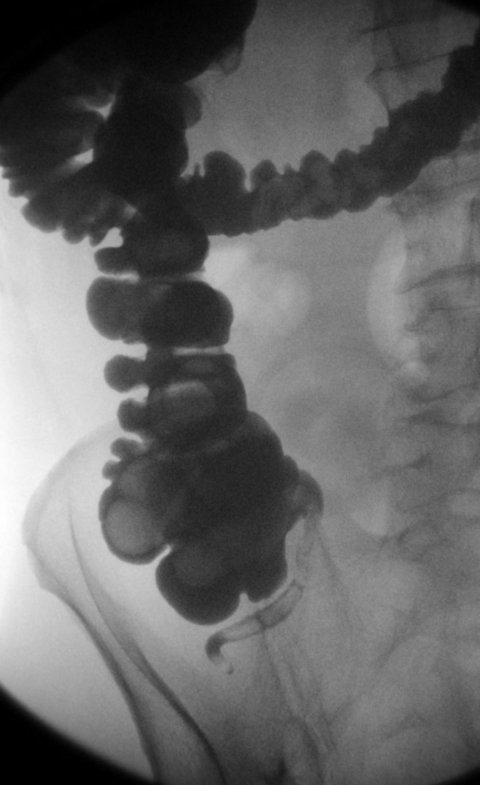 contrast enhanced xray of human digestive tract, including colong and appendix