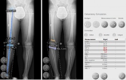 Varus deformity and simulation of a double
osteotomy for deformity in distal...