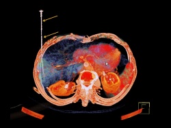 Fig. 1: Intra-interventional percutaneous microwave ablation. A single 16 gauge...