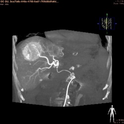 Photo: Philips and Biocompatibles team-up to advance in interventional oncology