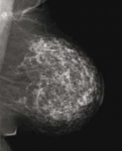 Konventionelle Mammographie der linken Brust in 2 Ebenen einer 70-jährigen...