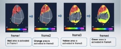 Activation Imaging displayes the order of the contraction pattern of the LV...