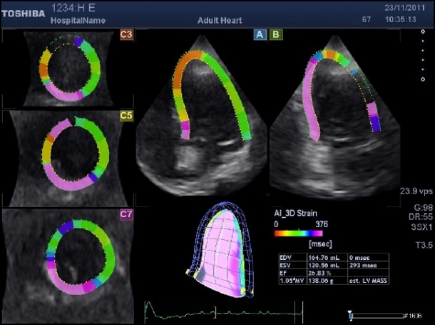 Example of a patient with an inferior infarction. The purple colors indicate a...