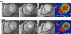 Fig. 1: Adenosine-induced MR stress and rest perfusion with 3-T in a patient...