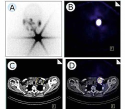 Scintigraphic image of a patient with thyroid cancer after radioiodine...