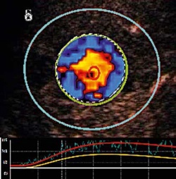 Report Metastasis: a new concept of dynamic vascular pattern enhancement in...