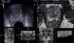 A cancer not detected by ultrasound appears clearly in the MRI image at right....