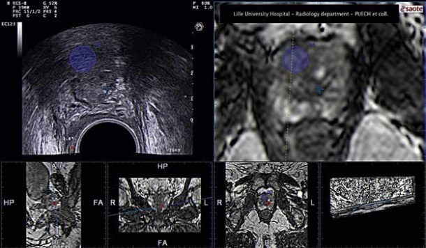 prostate imaging ultrasound tratamentul prostatitei în tianshi