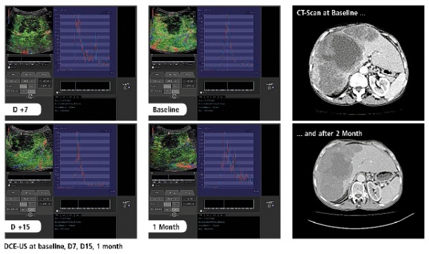 DCE-US at baseline, D7, D15, 1 month