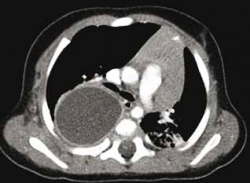 Gastric duplication in a five-month-old infant