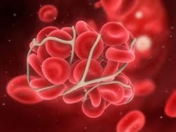 Photo: Surgical-site infections increase risk of blood clots