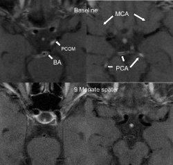 Hochaufgelöste MRT Bilder der intrakraniellen Arterien einer Patientin mit ZNS...