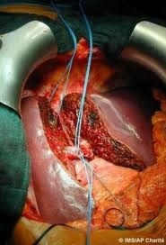 Photo: Liver transplants hit record levels