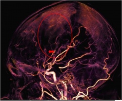 High resolution CTA derived from a CT perfusion study. Note occlusion of side...