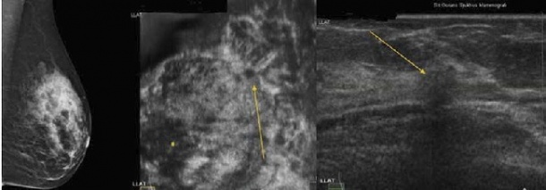 The ABUS study 67 years old Screening, asymptomatic Mammogram: no lesion seen,...