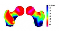 Cortical thickness map: most fragile zones are red