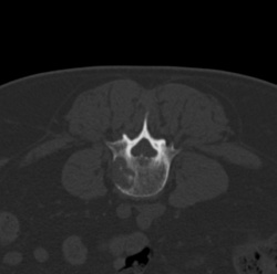 Painful lytic L4 spinal metastasis.